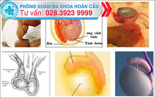 Tràn dịch màng tinh hoàn ngoài